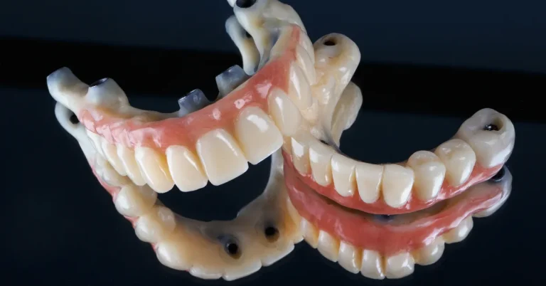 Full arch All-on-X dental implant prosthetic bridge at Roots Dental in Bellingham.